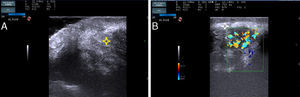 Ultrasound image of the lesion. A, A poorly-defined nodule is present in the dermis; hyperechoic and hypoechoic bundles are seen to form a woolly pattern(*). B, Color Doppler study of the lesion showing increased vascularization. Also observe the presence of a hyperechoic halo around the mass(*).