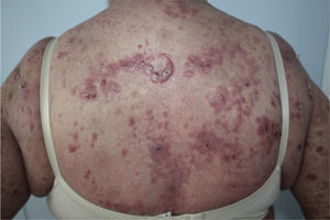 Plaques and tumors on the trunk.
