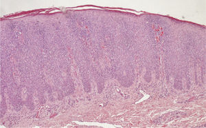 Acanthotic epidermis with an intense pagetoid infiltrate of lymphocytes with an atypical morphology (hematoxylin and eosin, original magnification ×20).