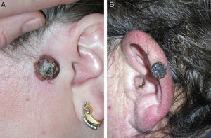 A, A 45-year-old woman with a tumor of 2cm diameter that had been present in the left preauricular region for 2 years. B, An exophytic verrucous lesion of 1.5cm diameter that had been present for 1 to 2 years on the left ear of a 50-year-old man.