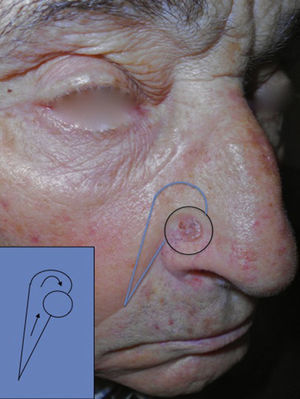 Basal cell carcinoma of 0.8×0.8cm on the ala nasi, and design of the shark flap.