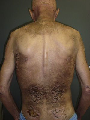 Widespread, crusted erosive lesions on the back of patient no.4. Note the absence of lesions in the central area of the back.