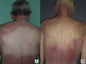 Sparing of the central area of the back in patients no.2(A) and no.3(B). Flagellate erythema can be seen in both cases. (See also Fig. 2.)