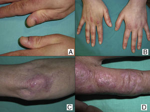 A, Cuticular necrosis in patient no.4. B, Gottron papules and periungual erythema on the hands of patient no.5. C and D, Gottron papules on the hands and elbows of patient no.1.
