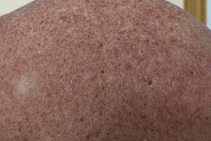 Seventy-year-old man diagnosed with gastrointestinal stromal tumor in treatment with imatinib for 3 months. Desquamative, pruritic macular-papular rash on the trunk and limbs.