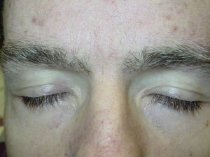 Thirty-six-year-old man with c-kit+ metastatic melanoma in treatment with imatinib for 3 years. Depigmentation of the hair follicles of the scalp, eyebrows, and eyelashes.