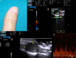 A, The examination shows nail dystrophy on the medial face of the first finger of the right hand. B, B mode Doppler image showing a well-defined, solid hypoechoic lesion with an oval form and regular borders. C, In Color Doppler mode, extensive vascularization can be seen in the nail bed. D, Spectral analysis shows low grade systolic arterial flow within the lesion.