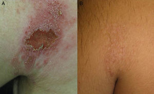 Cutaneous lesions before (A) and after (B) treatment.