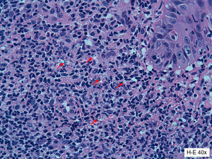 Histologic examination of a biopsy specimen from the edge of the ulcer showed a mixed inflammatory infiltrate with lymphocytes, histiocytes, and several macrophages with intracellular and extracellular amastigotes (red arrows) (hematoxylin-eosin, original magnification ×4).