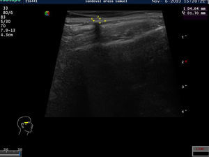 Ultrasound image showing a hyperechoic nodule with a peripheral halo and posterior shadow.