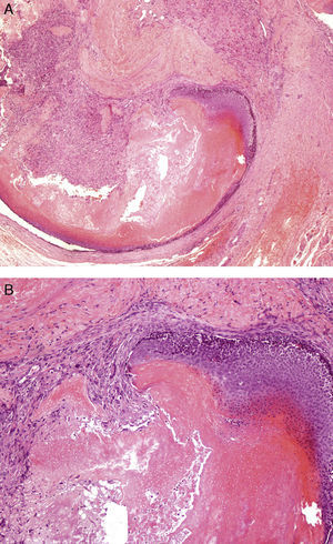 Well-circumscribed tumor with a mixed epithelial component composed of basaloid and shadow cells in the center of the lesion, and a peripheral mesenchymal component formed by fibroblastic cells. A, Hematoxylin-eosin, original magnification ×40. B, Hematoxylin-eosin, original magnification ×100.