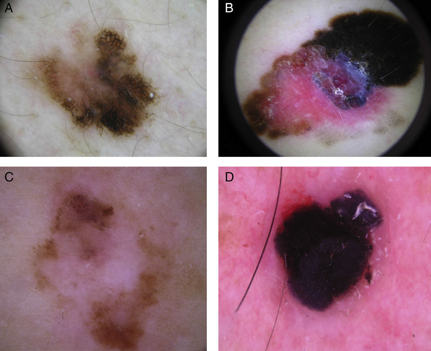 Multicompent Pattern Dermoscopic Findings for the Early Detection of Melanoma: An Analysis ...