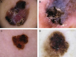 The most common dermoscopic features in the melanomas in our series. A. Structureless, homogeneous pigment areas at the periphery of the lesion (ovoids). B, White-blue structures and homogeneous pigment areas. C, Thick, irregular atypical pigment network. D, Multiple irregularly distributed dots and globules.