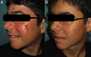 Facial angiofibromas and hypomelanotic macules. A, Before treatment. B, After 20 weeks of 0.2% topical rapamycin.