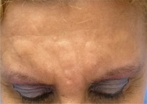 Yellowish-pink plaques of variable size and with well-defined borders on the forehead.