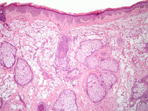 Skin with abundant foamy histiocytes (some with microvacuoles and others with macrovacuoles) in the reticular dermis, suggestive of a histiocytic reaction to a filler material (hematoxylin-eosin, original magnification ×10).