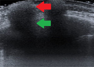 Siliconomas with a snowstorm pattern. Red arrow, hyperechoic image corresponding to the filler material. Green arrow, posterior acoustic shadow.
