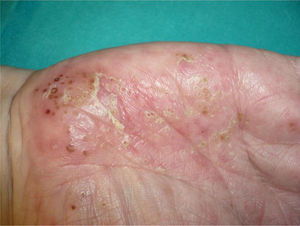 Desquamating erythematous plaques with pustules on their surface. These developed on the palms of a patient on treatment with adalimumab for rheumatoid arthritis.
