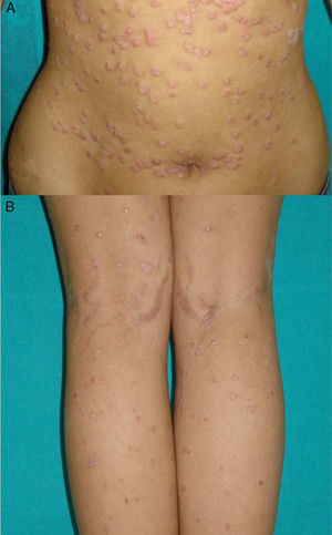 Patient with a history of plaque psoriasis who presented a sudden outbreak of small desquamating erythematous plaques with a drop-like appearance: A, On the abdomen. B, On the posterior aspect of the lower limbs.
