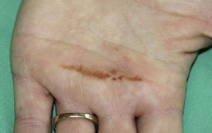 Hyperpigmented macule with a linear pattern and well-defined borders, located on the palm.