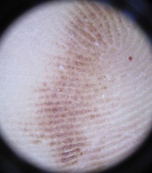 Dermoscopy of the lesion showing a parallel pattern of the cutaneous ridges.