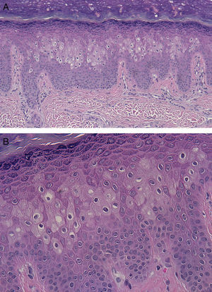 Histopathology: dyskeratotic cells in a pagetoid distribution. A, Hematoxylin and eosin, original magnification ×200. B, Hematoxylin and eosin, original magnification ×400.