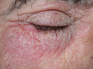 Chronic lichenified eczema of the eyelids caused by cocamidopropyl betaine present in a cosmetic.