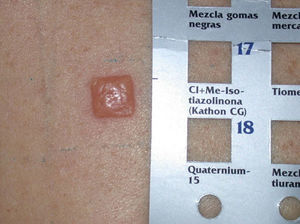 Strong positive reaction in the patch test with Kathon CG.