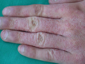 Allergic contact eczema of the hands caused by Kathon CG.