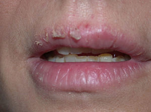 Cheilitis caused by galates present in a lipstick.