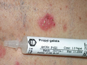 Positive reaction in the patch test with propyl galate.