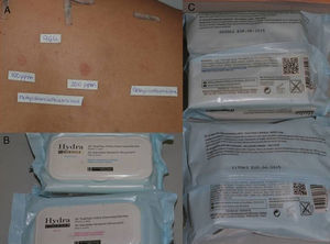A, Patient with eyelid eczema and positive results to methylchloroisothiazolinone/methylisothiazolinone. B and C, The patient linked her eczema to makeup remover wipes and, therefore, switched to wipes of the same brand that did not contain methylchloroisothiazolinone/methylisothiazolinone. The eczema resolved.