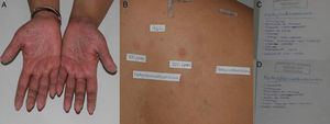 A and B, Patient with allergic contact dermatitis on the hands caused by methylchloroisothiazolinone/methylisothiazolinone. C and D, The patient provided the names of a large number of cosmetic and domestic products containing methylchloroisothiazolinone and methylisothiazolinone.