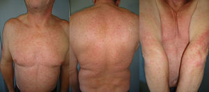 Erythematous papular eruption with minimal desquamation, clinically consistent with eczema (case1).