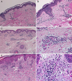 A, Case 1. Lymphocytic perivascular dermatitis with no epidermal changes. Hematoxylin and eosin (H&E), original magnification ×10. B, Case 1. Detail of the mild perivascular and periadnexal lymphocytic inflammatory infiltrate. H&E, original magnification ×40. C, Case 2. Superficial perivascular dermatitis with no epidermal involvement. H&E, original magnification ×10. D, Case 3. Detail showing the lymphocytic perivascular infiltrate with the presence of a few plasma cells. H&E, original magnification ×40. E, Case 4. Superficial perivascular dermatitis with edema of the papillary dermis, spongiosis, and foci of lymphocyte exocytosis. H&E, original magnification ×20. F, Case 4. Detail showing the lymphocytic perivascular infiltrate with minimal red-cell extravasation and no vasculitis. H&E, original magnification ×40.