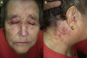 A, Desquamating erythematous lesions in the periorbital region. B, Erythematous papular lesions in the retroauricular region.