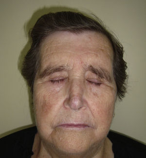 Resolution of the lesions after withdrawal of the hydroxyurea.