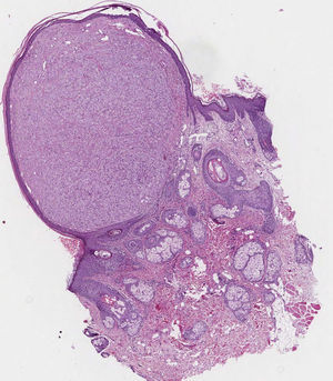 Tumor in the superficial and mid dermis, surrounded by an epithelial collarette. Hematoxylin-eosin, original magnification ×10.