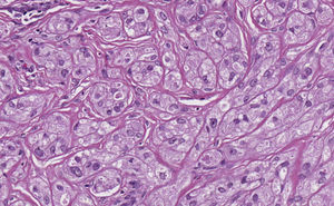 Cells with a polygonal morphology, abundant granular eosinophilic cytoplasm, and large vesicular nuclei. The cells are arranged in an interlinked fascicular pattern. Hematoxylin-eosin, original magnification ×40.