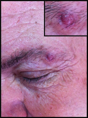 Nodular lesion of 7mm in diameter located at the tail of the left eyebrow. A higher magnification image of the lesion is shown in the inset.