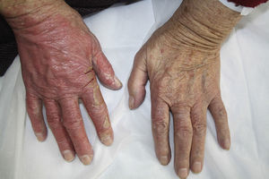 Erythema and extensive desquamation on the dorsum of the right hand.