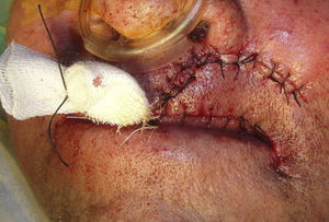 First stage of reconstruction. A cutaneous rotation flap with a lateral pedicle was fashioned from the left half lip, and the vermilion border (Klein's line) was recreated by suturing the lateral tongue flap to the skin flap.