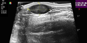 Characteristic sonographic features of an epidermoid cyst: hypoechoic lesion with posterior enhancement at the center and shadowing at the edges. Doppler ultrasound showed no internal vascularization.