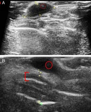 A, Typical ultrasound image of a basal cell carcinoma in the leg: the lesion is hypoechoic, borders are well defined, and hyperechoic dots can be seen inside the carcinoma (faint red circle). B, Basal cell carcinoma after multiple regressions in the left wing of the nose. The basal cell carcinoma (red circle), as described above, can be distinguished from nasal cartilage represented by a hypoechoic band (red bracket).
