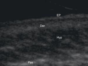 Structure of normal skin as seen on ultrasound. EP indicates epidermis; Der, dermis; Hyp, subcutaneous tissue; Fas, fascia.