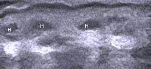 Hyaluronic acid implants (H). The pattern is initially vesicular.