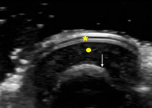 Cross-sectional view of nail in B (bright) mode, showing the nail plate (star), the nail bed (circle), and the distal phalanx. Photo courtesy of Dr Cerezo.