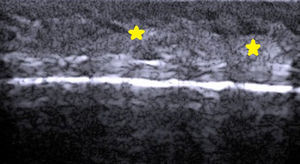Longitudinal view of the hair on the scalp, showing the pilosebaceous follicle (stars) in the region of the bulb.