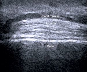 Subfrontal lipoma showing increased echogenicity due to an increased number of subcutaneous septa. Ultrasound aided diagnosis and helped to locate the lesion prior to surgery.