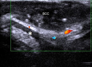 Image showing basal cell carcinoma (BCC) of the earlobe and auricular cartilage (*).
